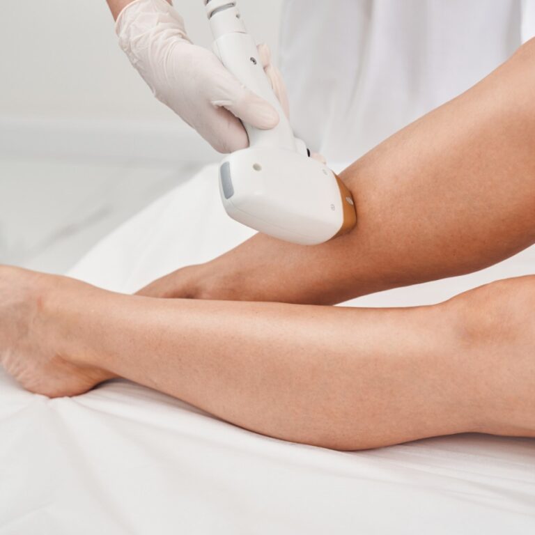 Why Choose Laser Hair Removal Legs in 2025?