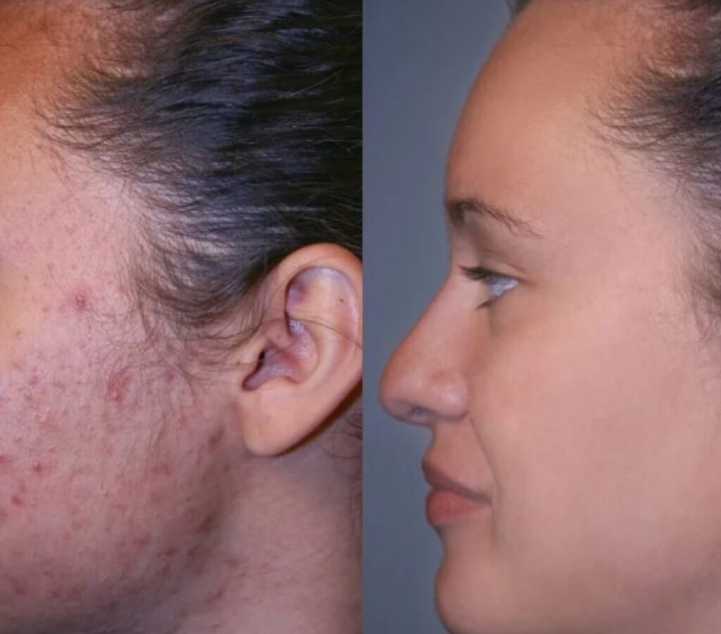 Laser Scar Removal: Stunning Before & After Results