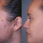 Laser Scar Removal: Stunning Before & After Results