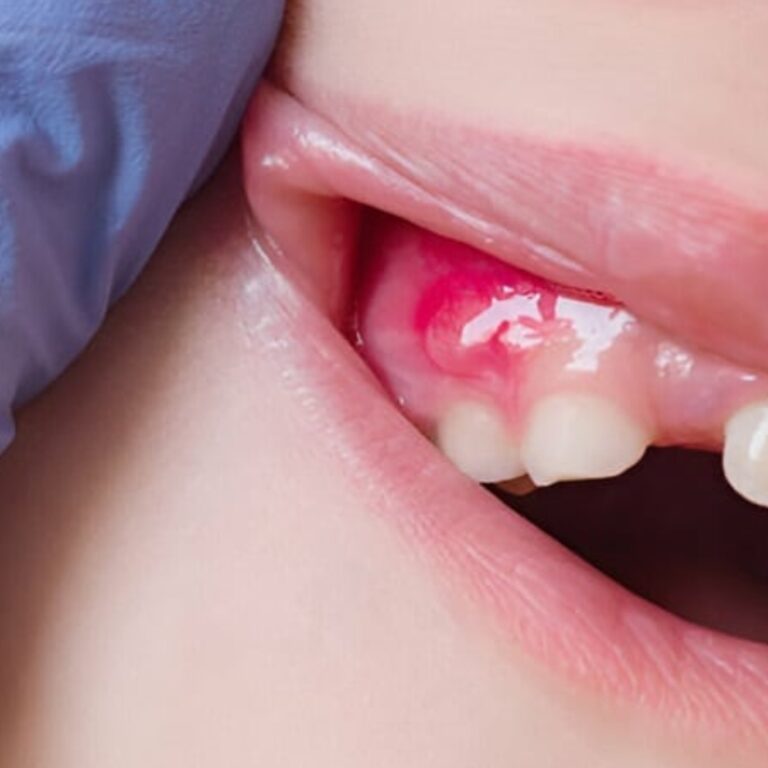 How Long Until a Tooth Infection Kills You?