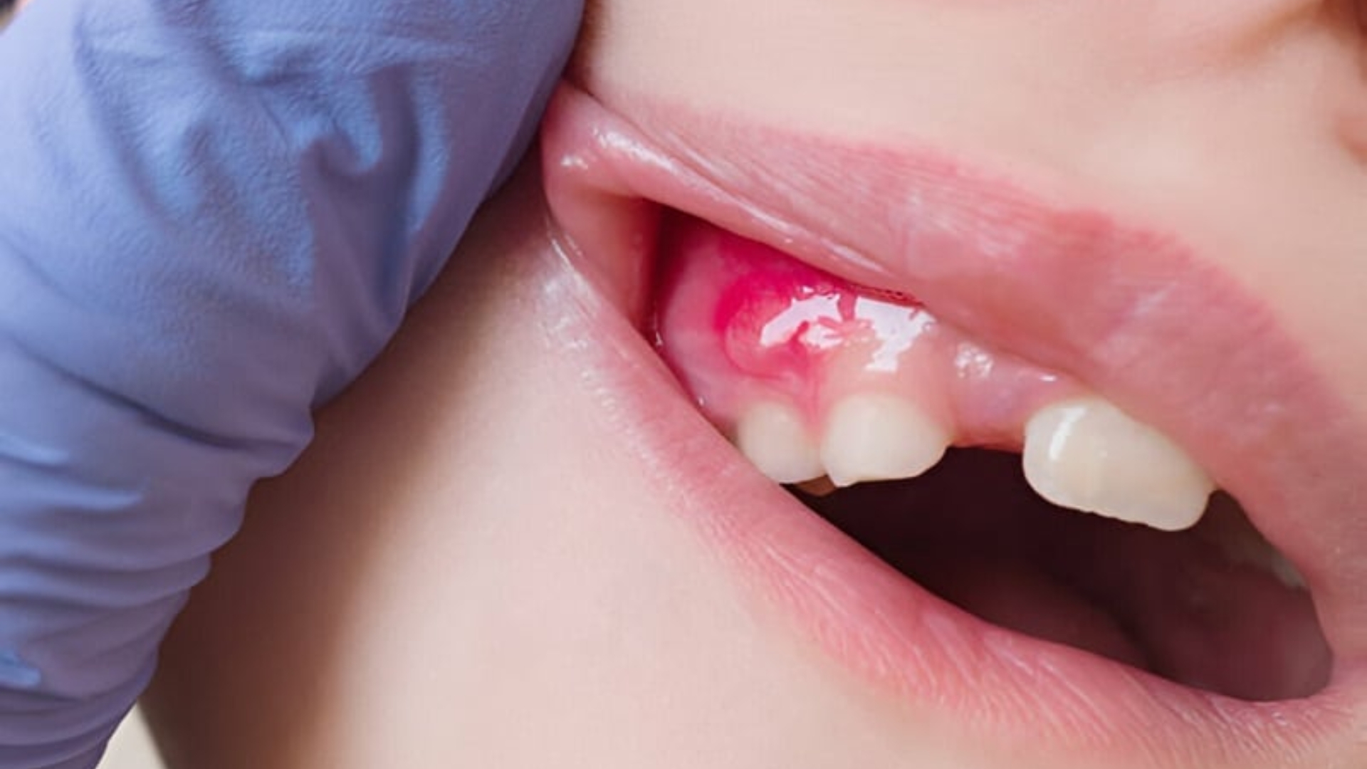 How Long Until a Tooth Infection Kills You?